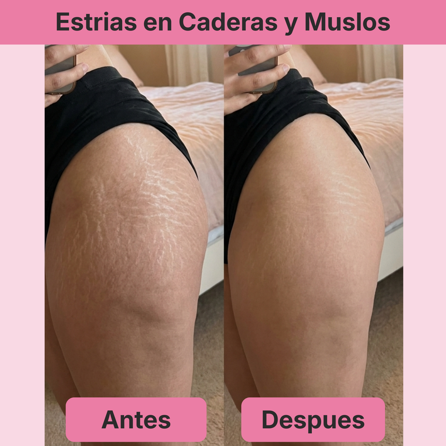 (5 Meses - Panza, Muslos y Busto) Tratamiento Barmino® Personalizado Antiestrias y Flacidez Postparto + Guia Masaje Drenante para Grasa Abdominal + Potenciador Dermico Resultados 3X Más Rápido + Acceso Comunidad Mamás Barmino