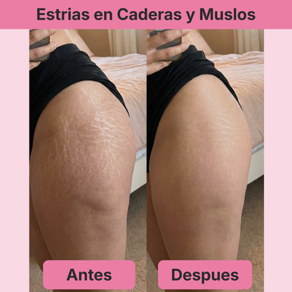 (5 Meses - Panza, Muslos y Busto) Tratamiento Barmino® Personalizado Antiestrias y Flacidez Postparto + Guia Masaje Drenante para Grasa Abdominal + Potenciador Dermico Resultados 3X Más Rápido + Acceso Comunidad Mamás Barmino