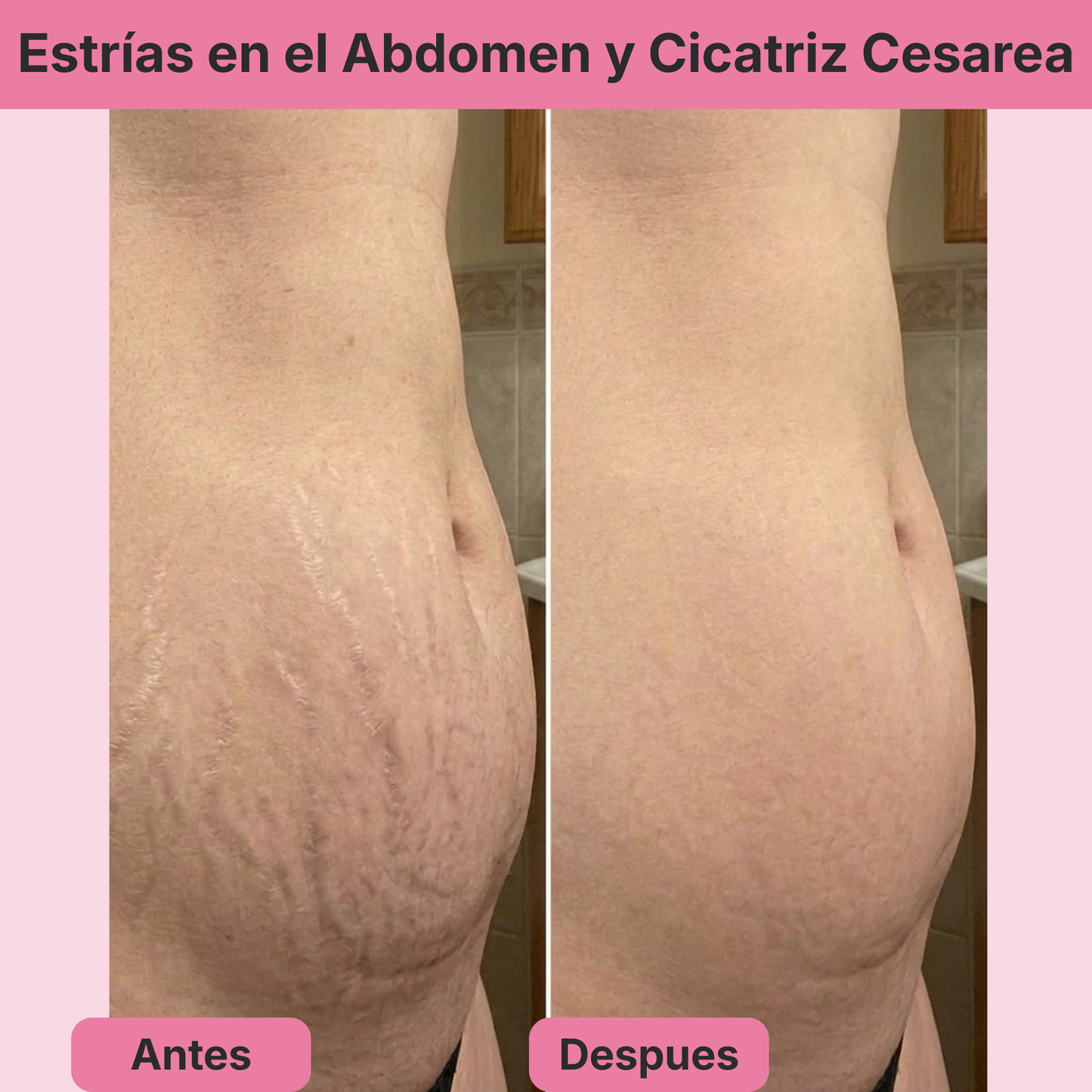 (5 Meses - Panza, Muslos y Busto) Tratamiento Barmino® Personalizado Antiestrias y Flacidez Postparto + Guia Masaje Drenante para Grasa Abdominal + Potenciador Dermico Resultados 3X Más Rápido + Acceso Comunidad Mamás Barmino