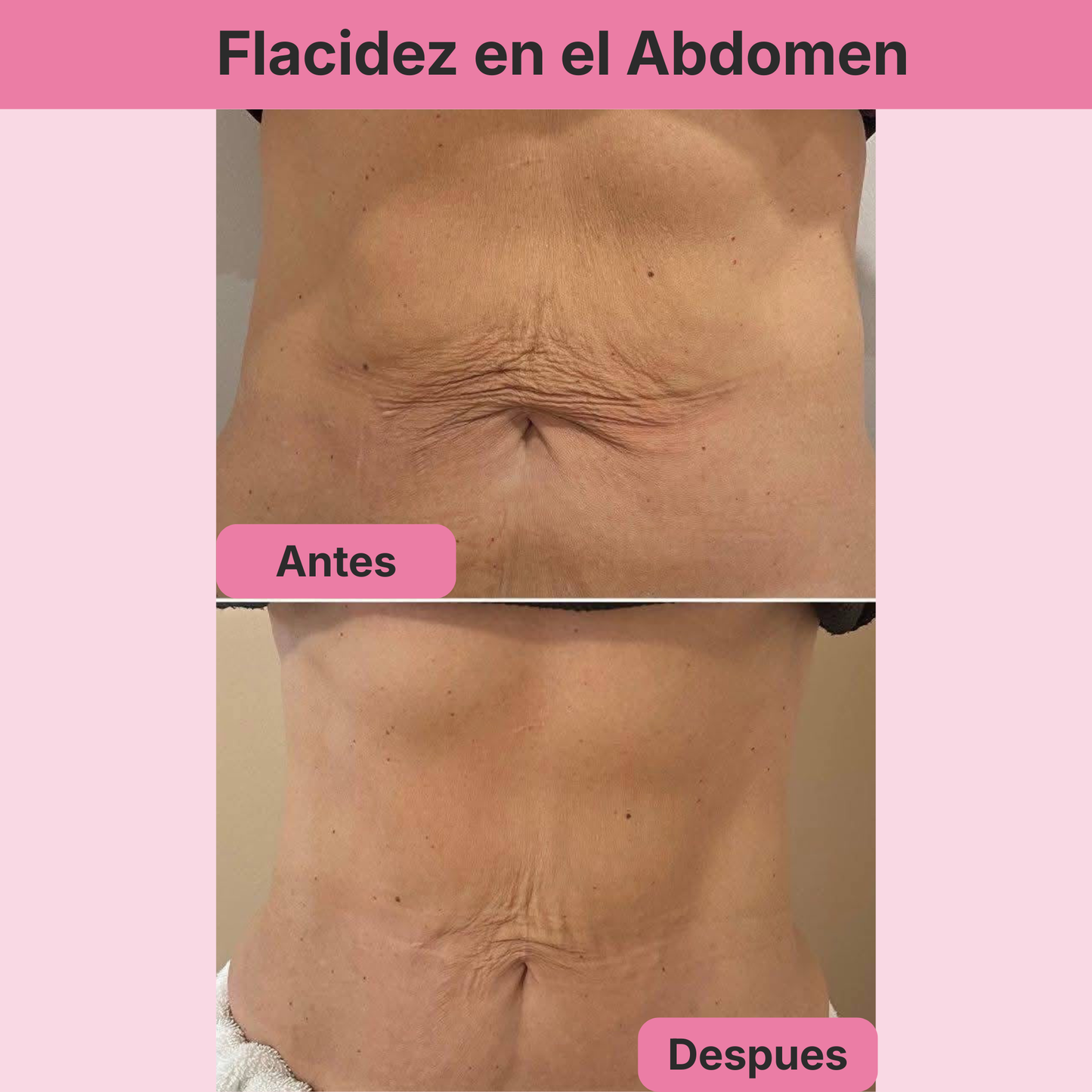 (5 Meses - Panza, Muslos y Busto) Tratamiento Barmino® Personalizado Antiestrias y Flacidez Postparto + Guia Masaje Drenante para Grasa Abdominal + Potenciador Dermico Resultados 3X Más Rápido + Acceso Comunidad Mamás Barmino